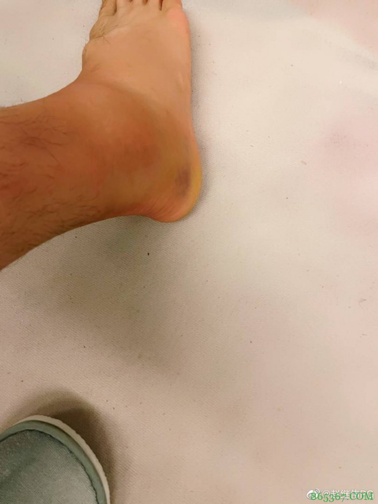 赵继伟晒受伤脚踝：大家年货办得如何？我准备把它炖了！??