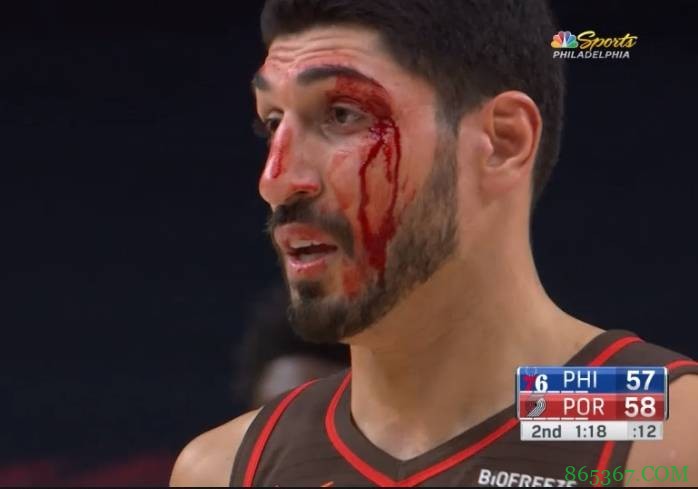 慎点！坎特抢板时被队友误伤 满脸是血