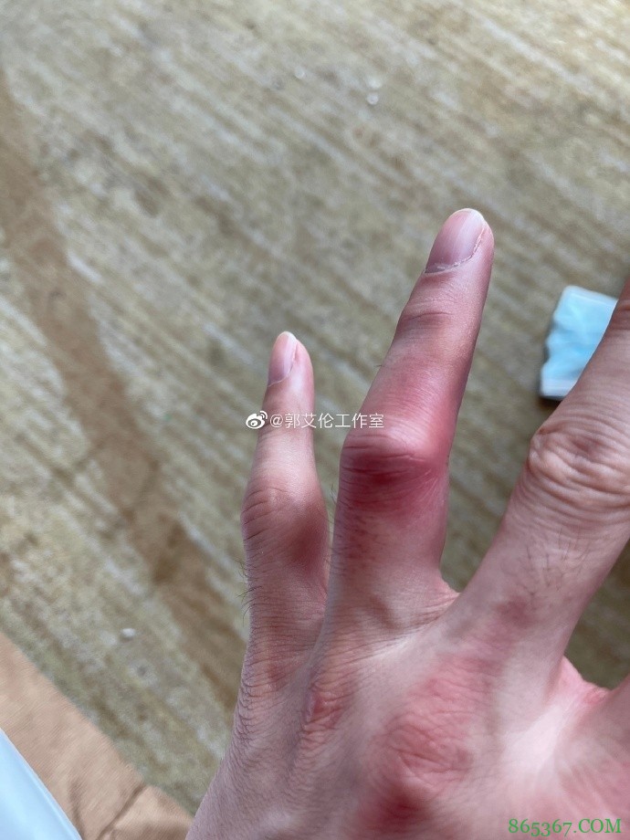 个人工作室晒郭艾伦肿胀的脚踝&手指:你对得起所有人