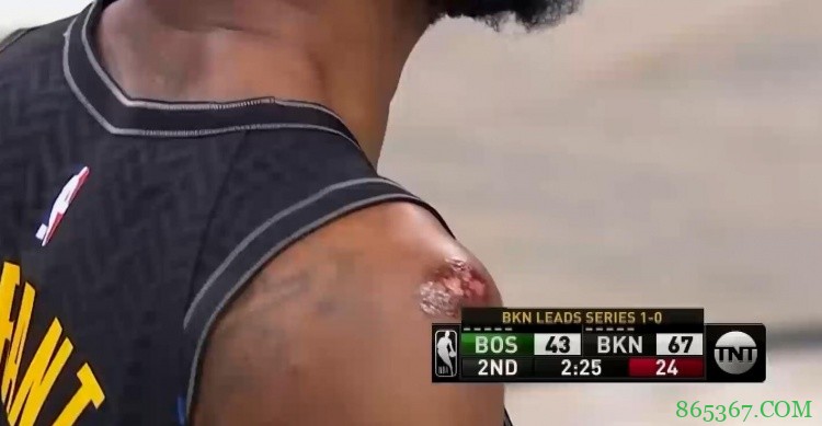 ?看着都疼!杜兰特突破挫伤右肩 伤口暴露十分明显