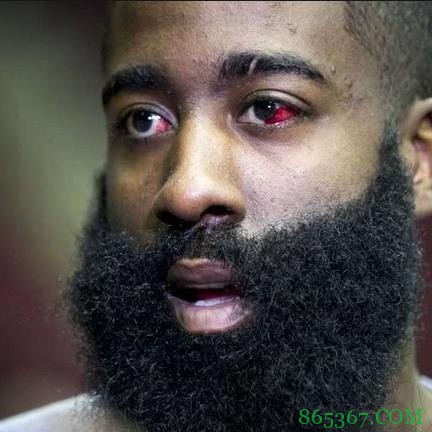 波蒂斯右眼严重淤血 像极了18年总决詹姆斯和19年西半决哈登