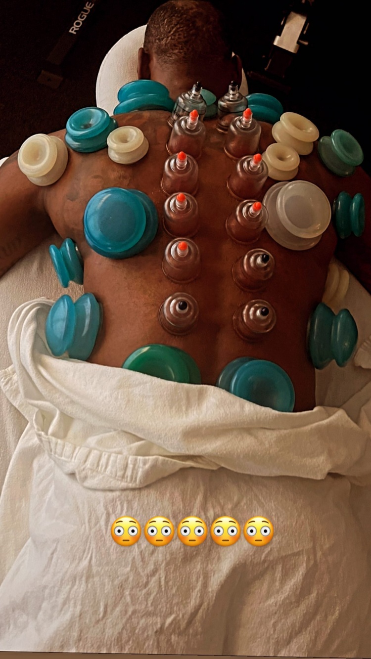 东方智慧！詹姆斯INS晒接受拔罐治疗照：?????